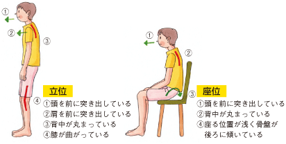 立位
①頭を前に突き出している
②肩を前に突き出している
③背中が丸まっている
④膝が曲がっている
座位
①頭を前に突き出している
②背中が丸まっている
④座る位置が浅く骨盤が
　後ろに傾いている