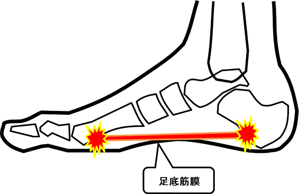 足底筋膜